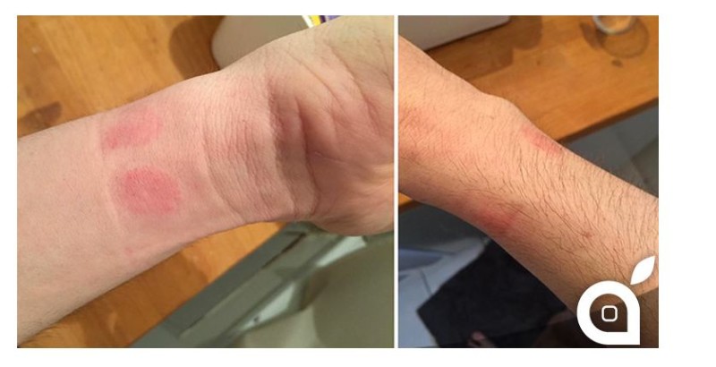 iritatie-piele-apple-watch